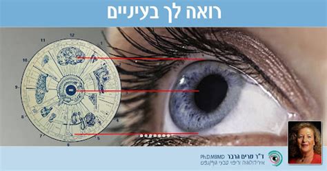 מרים גרבר אירידולוגיה - אבחון בגלגל העין